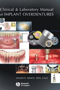 Clinical and Laboratory Manual of Implant Overdentures; Hamid Shafie; 2007