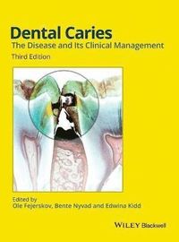 Dental Caries: The Disease and its Clinical Management; Ole Fejerskov, Bente Nyvad, Edwina Kidd; 2015